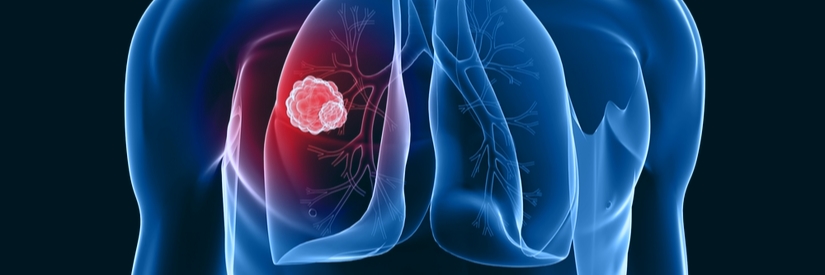 BELGIAN THORACIC ONCOLOGY SYMPOSIUM